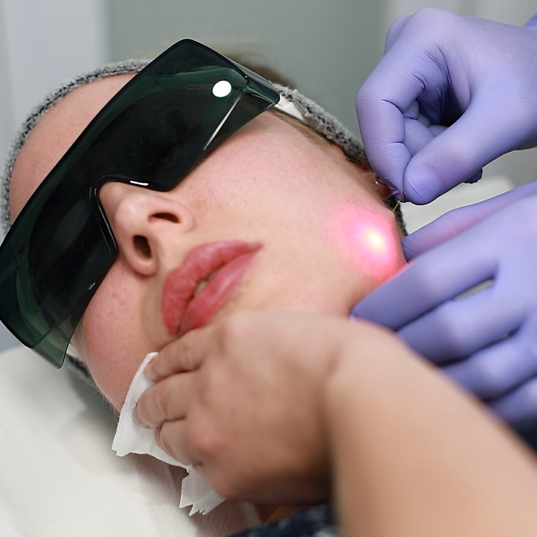 Endolift